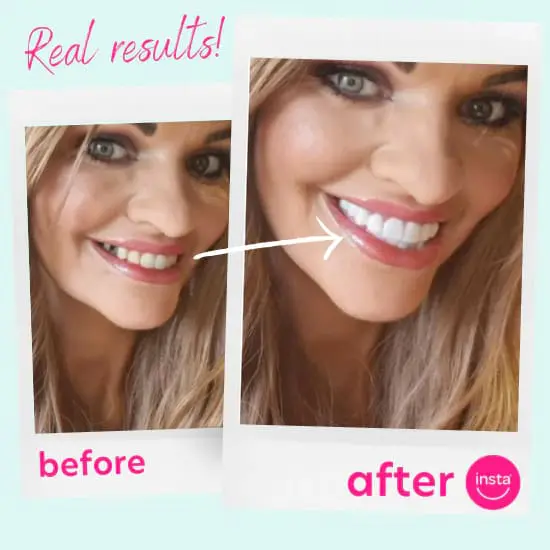 A before and after picture of a lady with clip-on veneers from Instasmile for her top teeth.