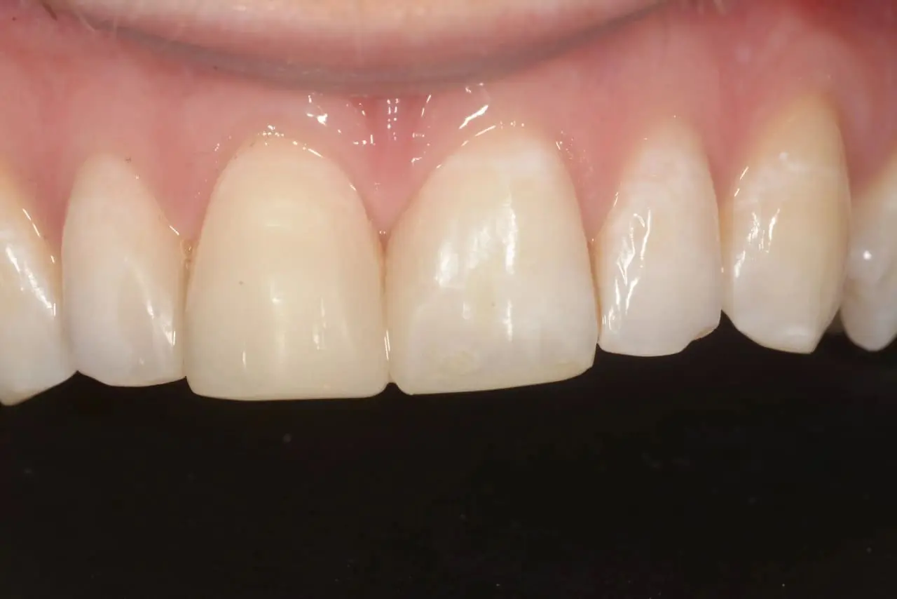 A close-up of a gap in two front teeth that has been corrected using a composite filling by a dentist Glasgow