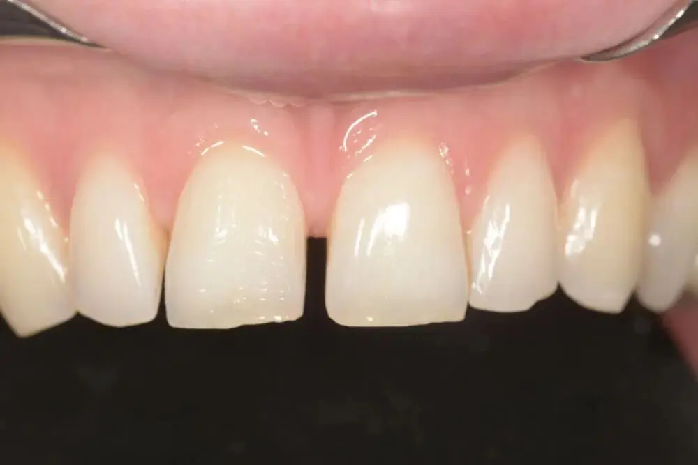 A close-up of a gap in two front teeth