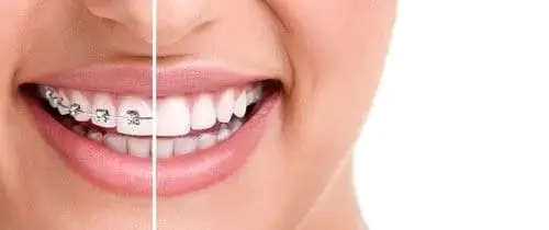 Close-up of a smiling person showing a split image: one side with metal braces and the other with straight, braces-free teeth.